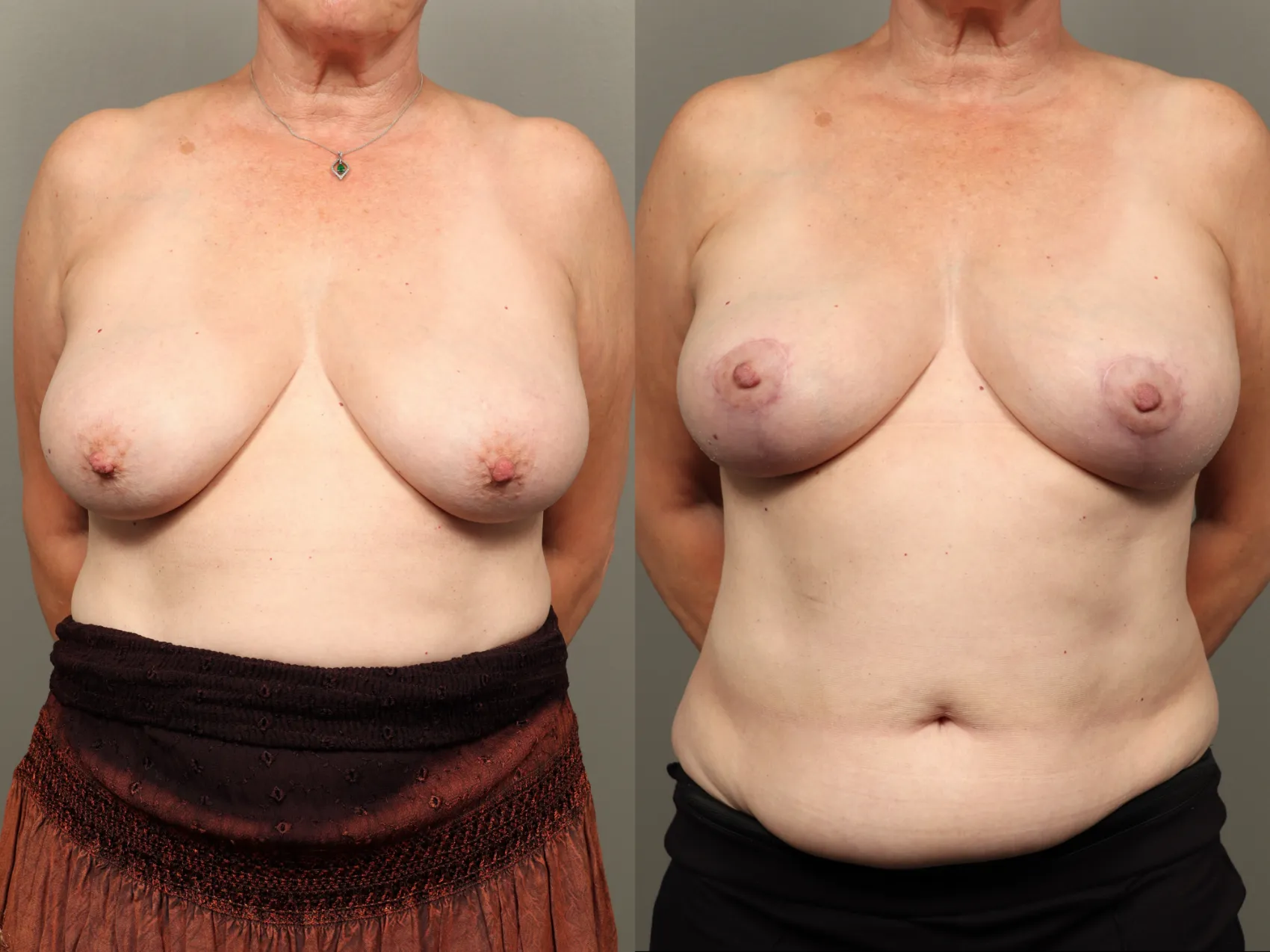 Breast lift Turkey before and after Case 2 - Lifted perky breasts at Carely Clinic