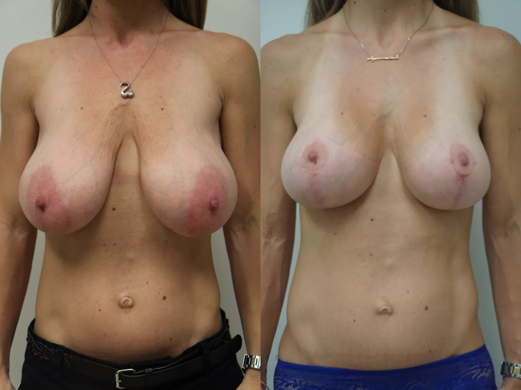 Mastopexy Turkey before after Case 3 - Sagging corrected at Carely Clinic
