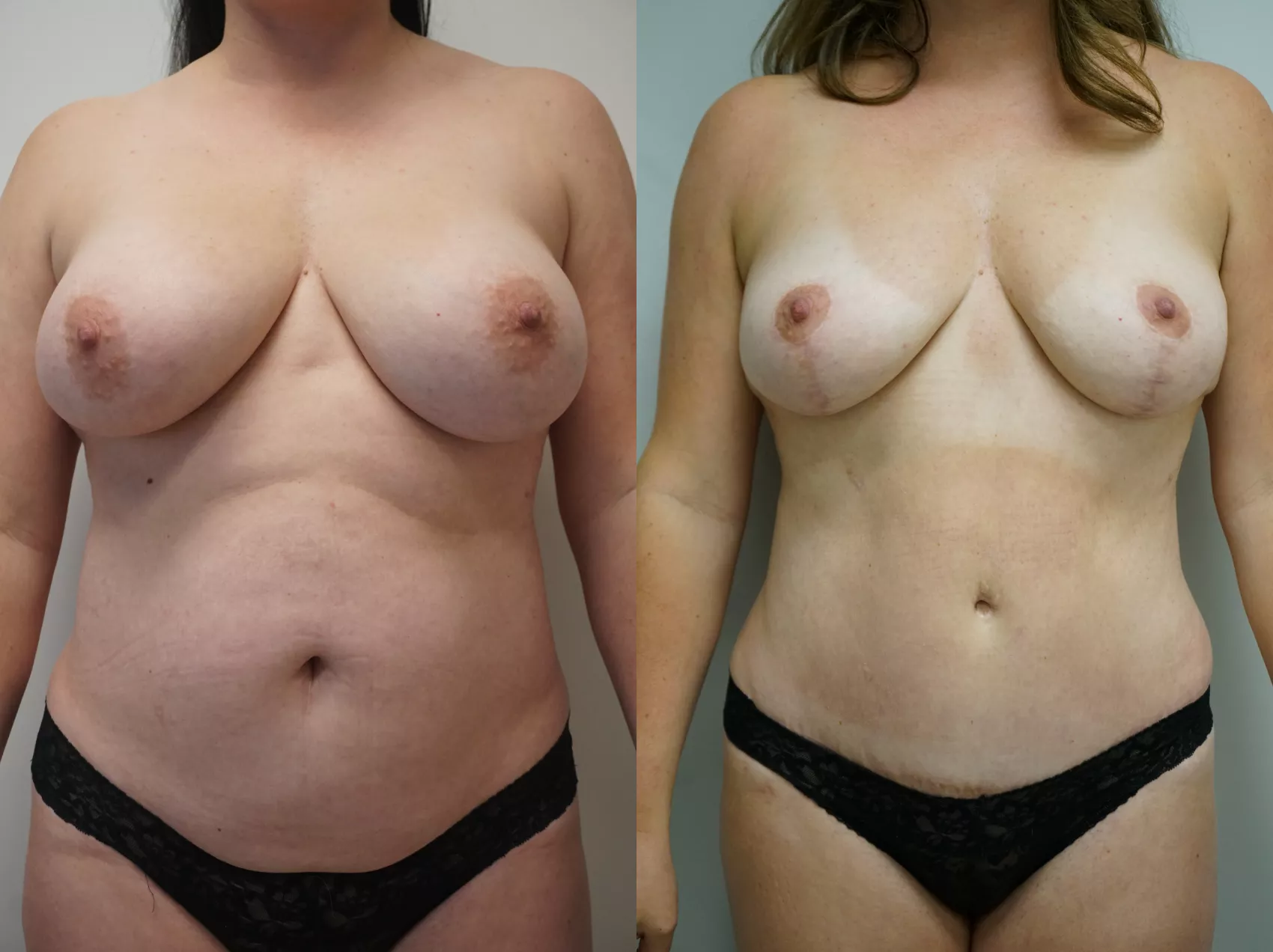 Breast lift Turkey before and after - mastopexy results at Carely Clinic Istanbul