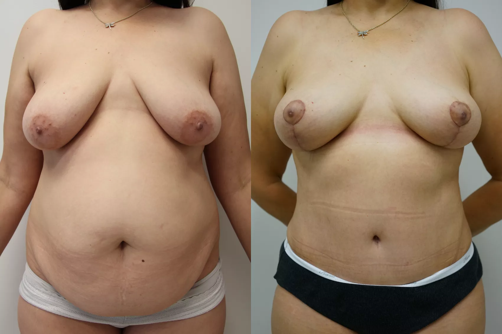 Breast lift before after Turkey Case 5 - Nipple repositioning results