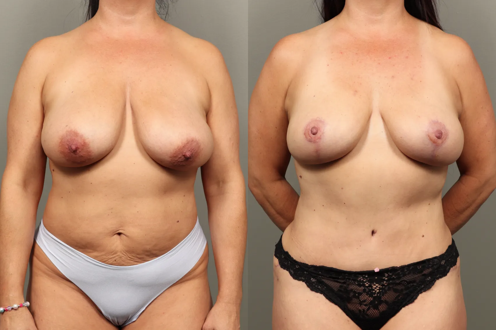 Mastopexy before and after Turkey Case 6 - Youthful breast shape achieved