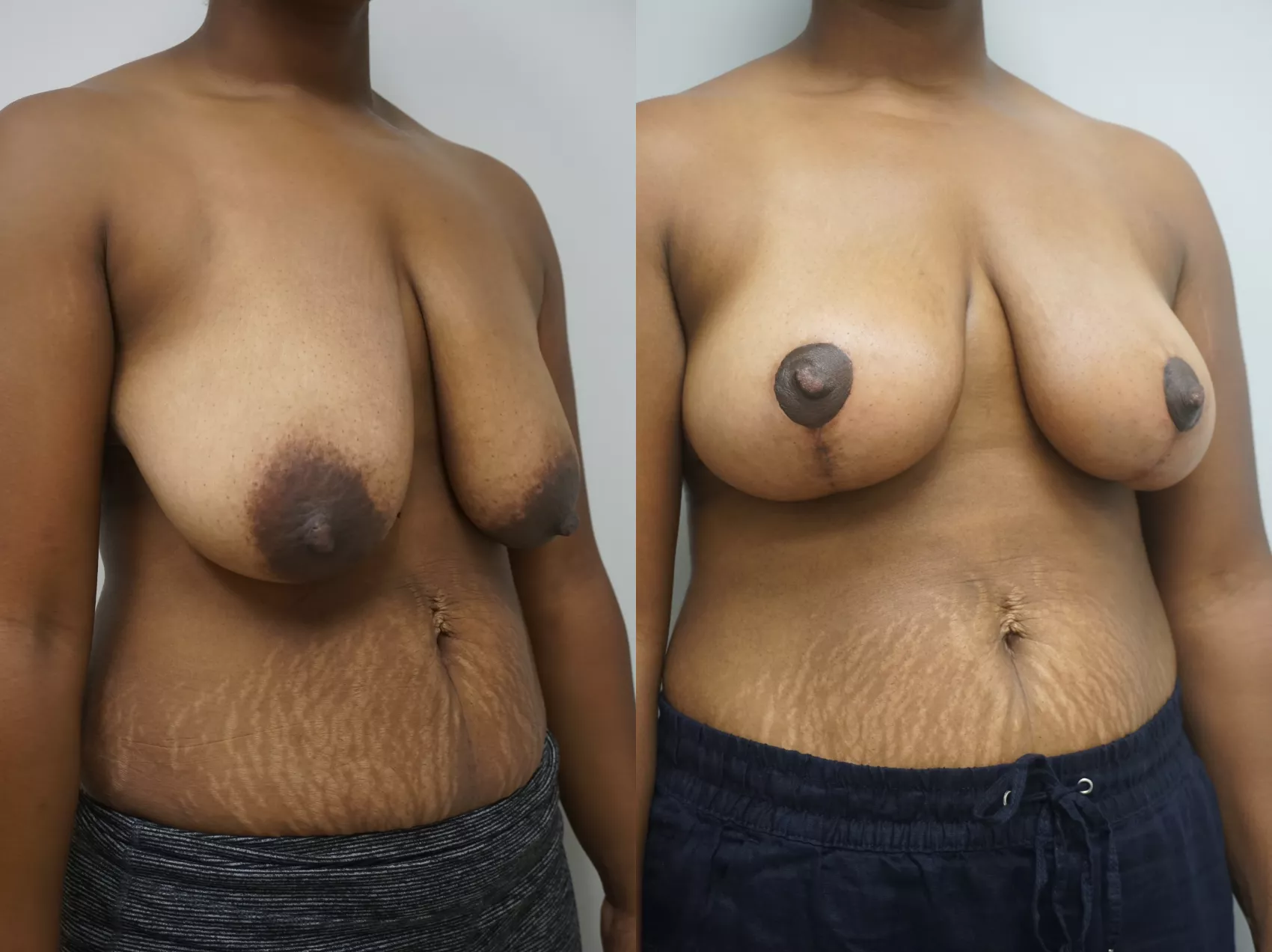 Breast lift Turkey Case 7 - Post-pregnancy breast lift results