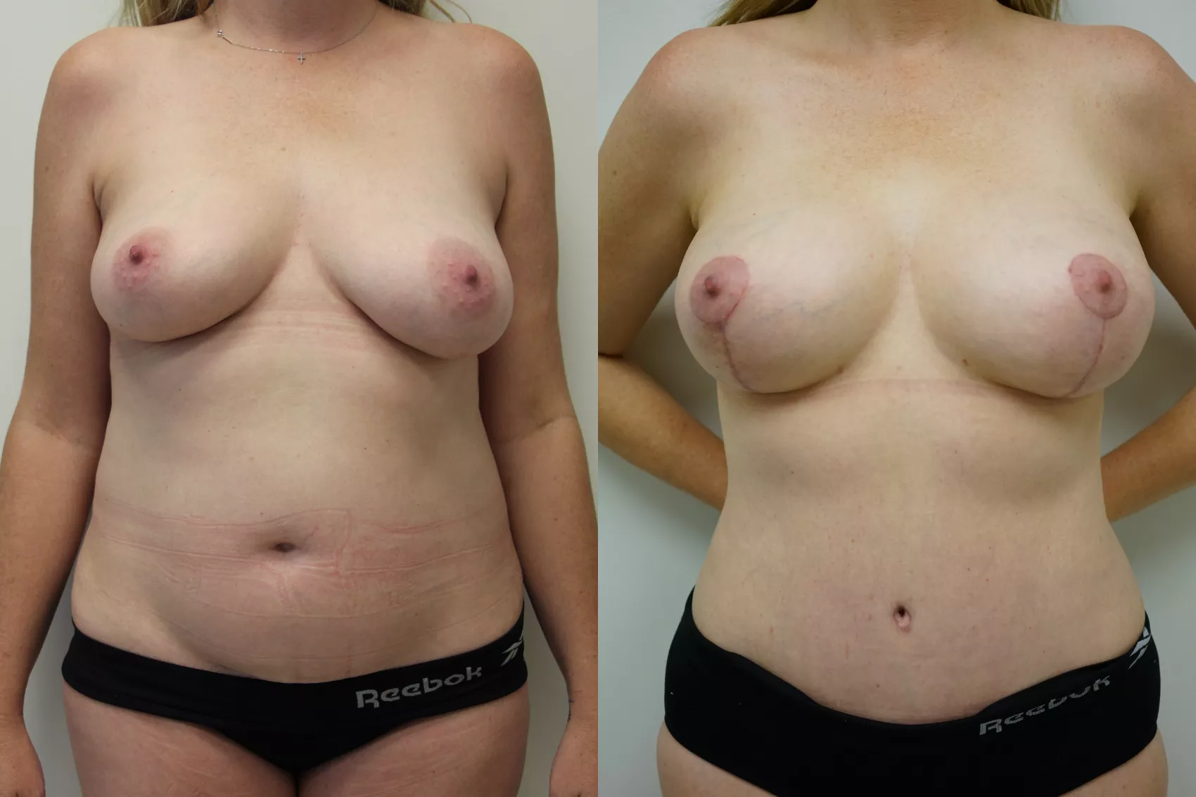 Breast lift before after Istanbul Case 8 - Ptosis correction results