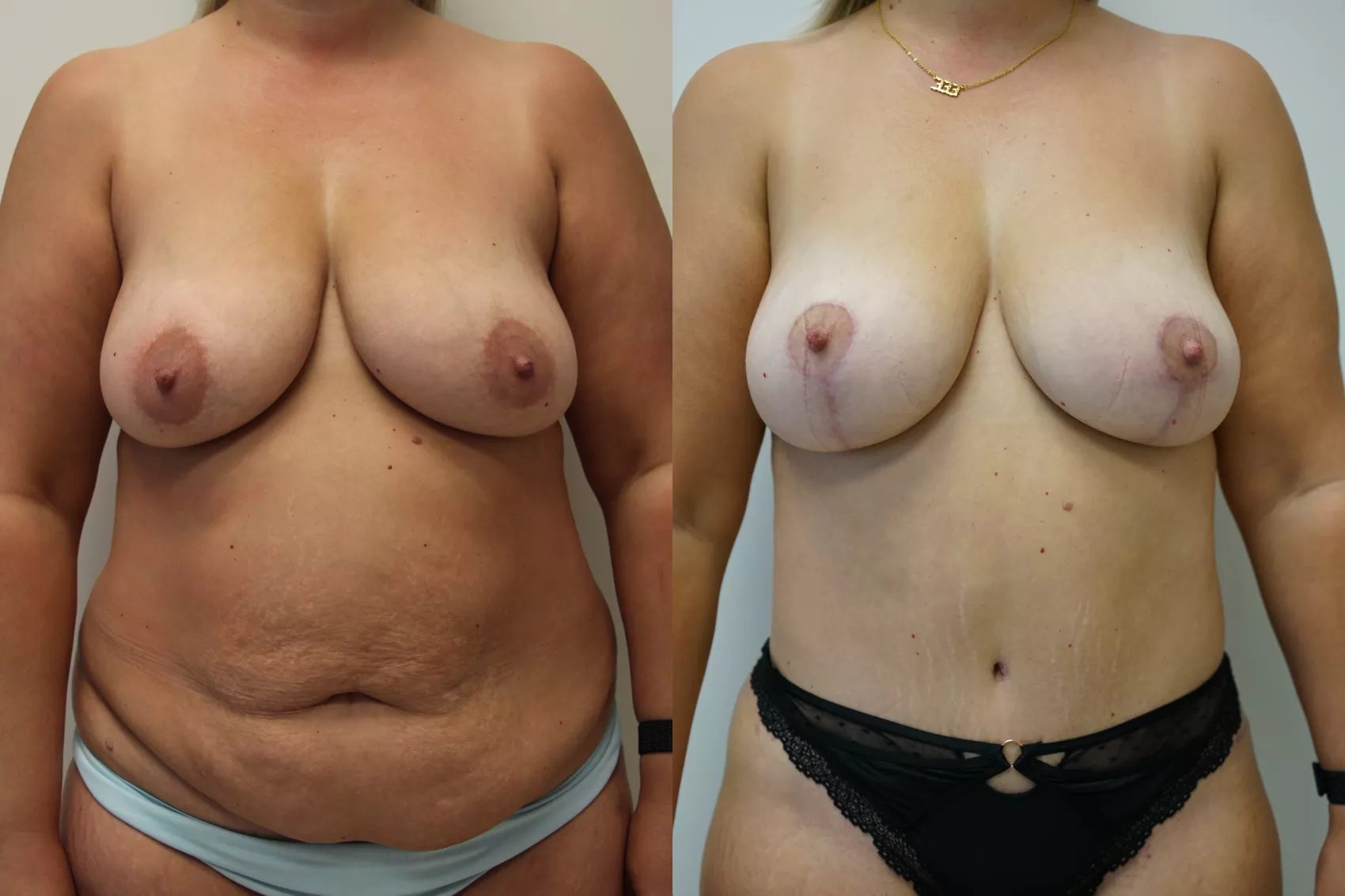 Mastopexy Turkey Case 9 - Anchor lift technique results