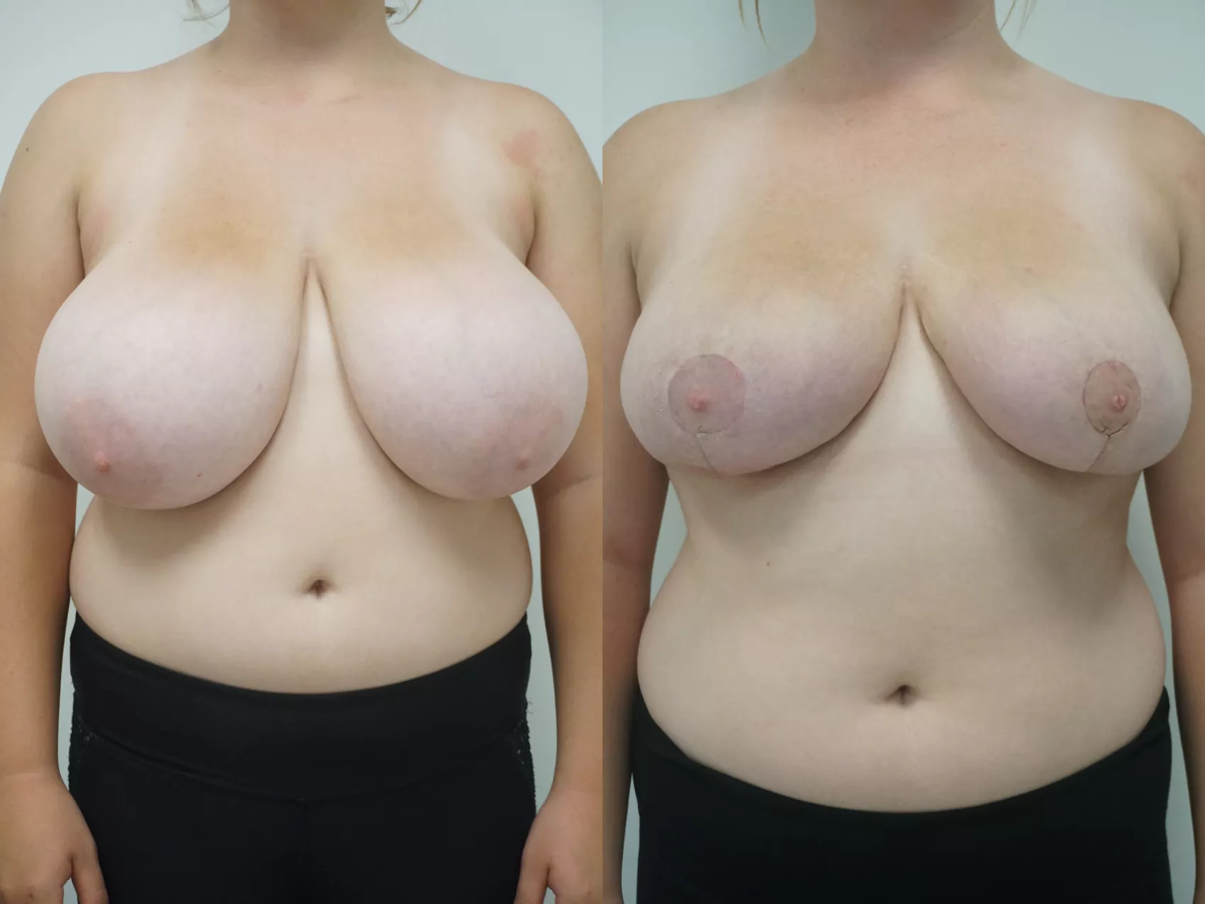 Breast reduction Turkey before and after gallery