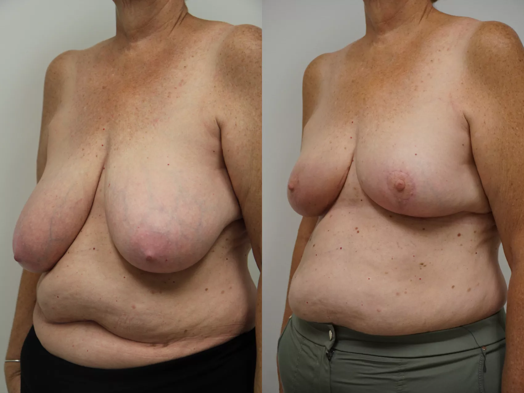 Breast reduction Turkey results Case 4 - Before and after surgery