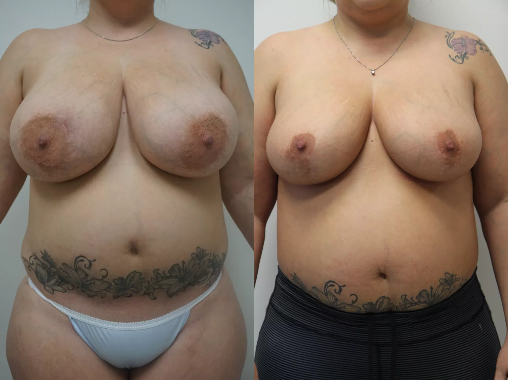 Reduction mammoplasty before and after Turkey Case 6 - Smaller breasts achieved