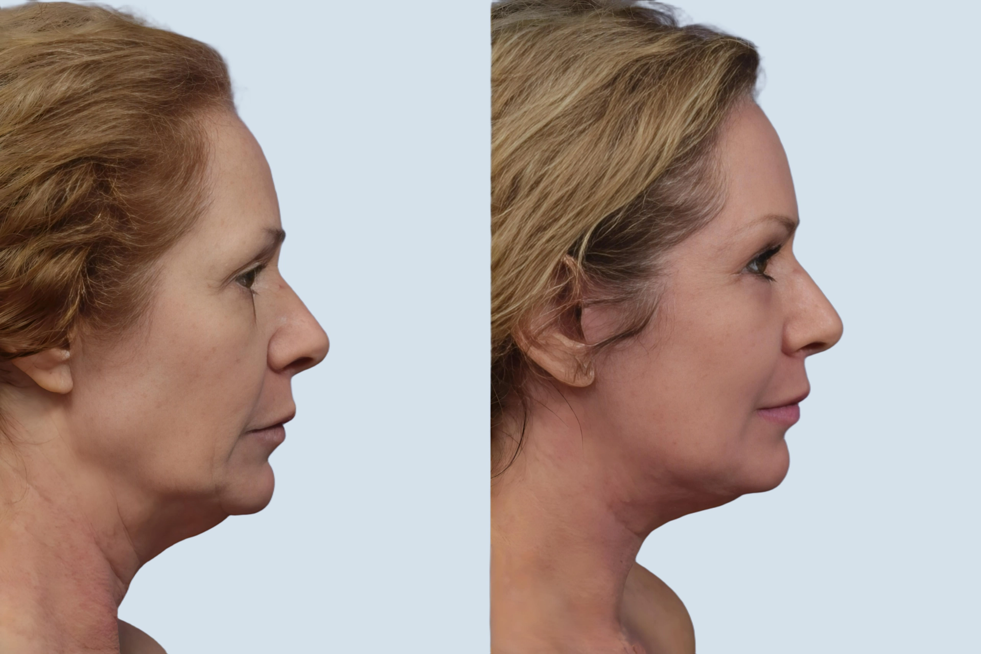 Facelift Turkey before and after Photo 25