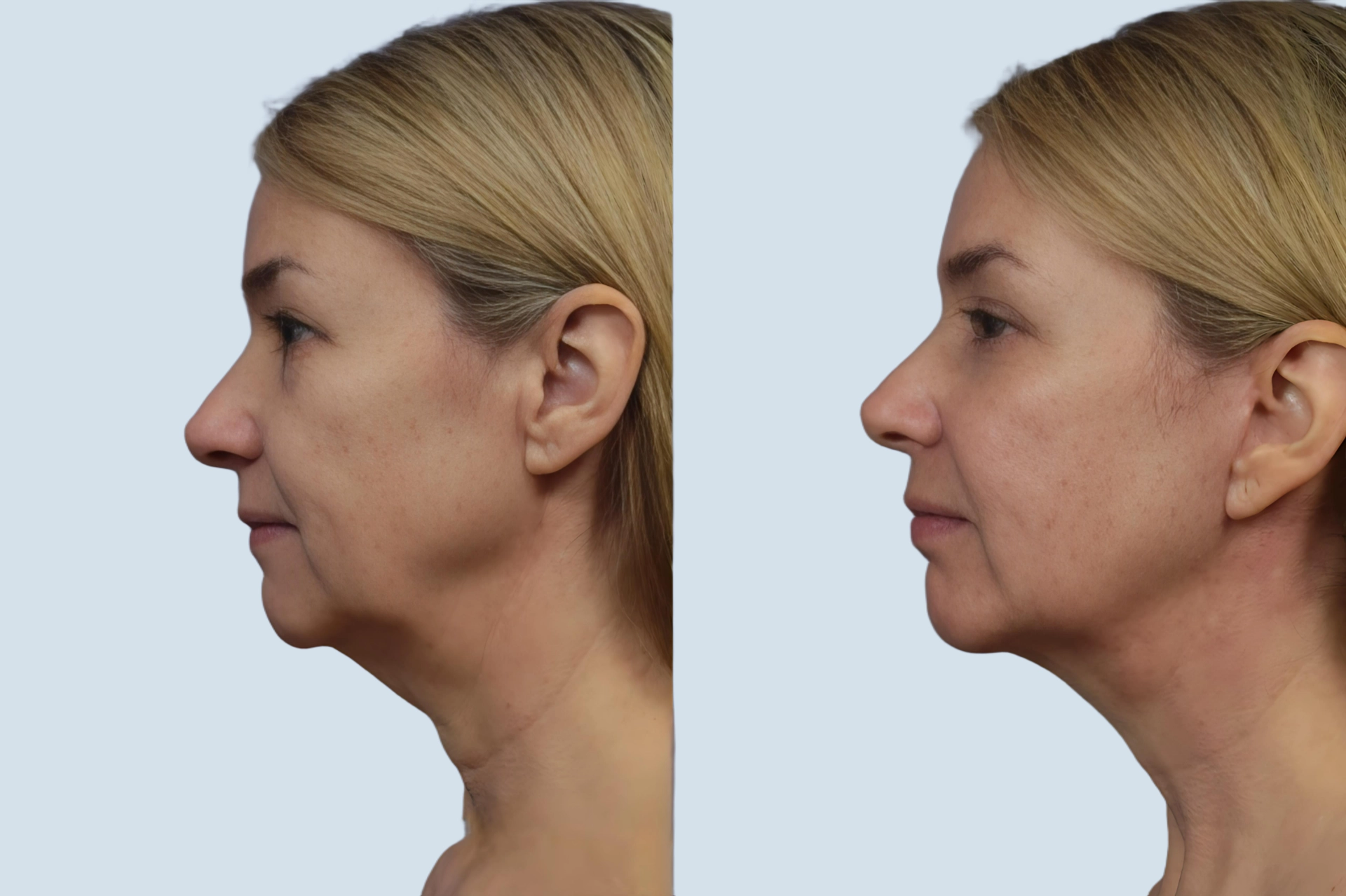 Facelift Turkey before and after Photo 23