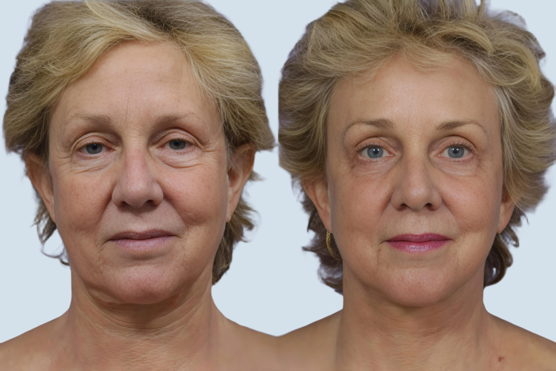 Facelift Turkey before and after Photo 22