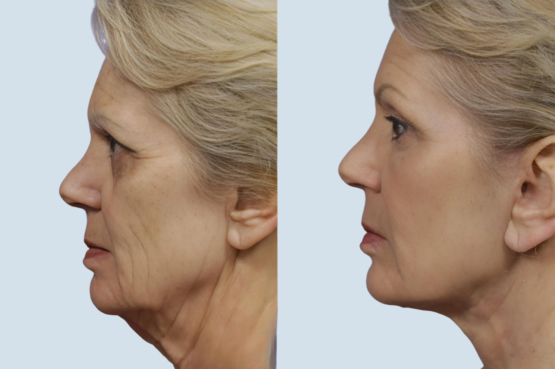 Facelift Turkey before and after Photo 19