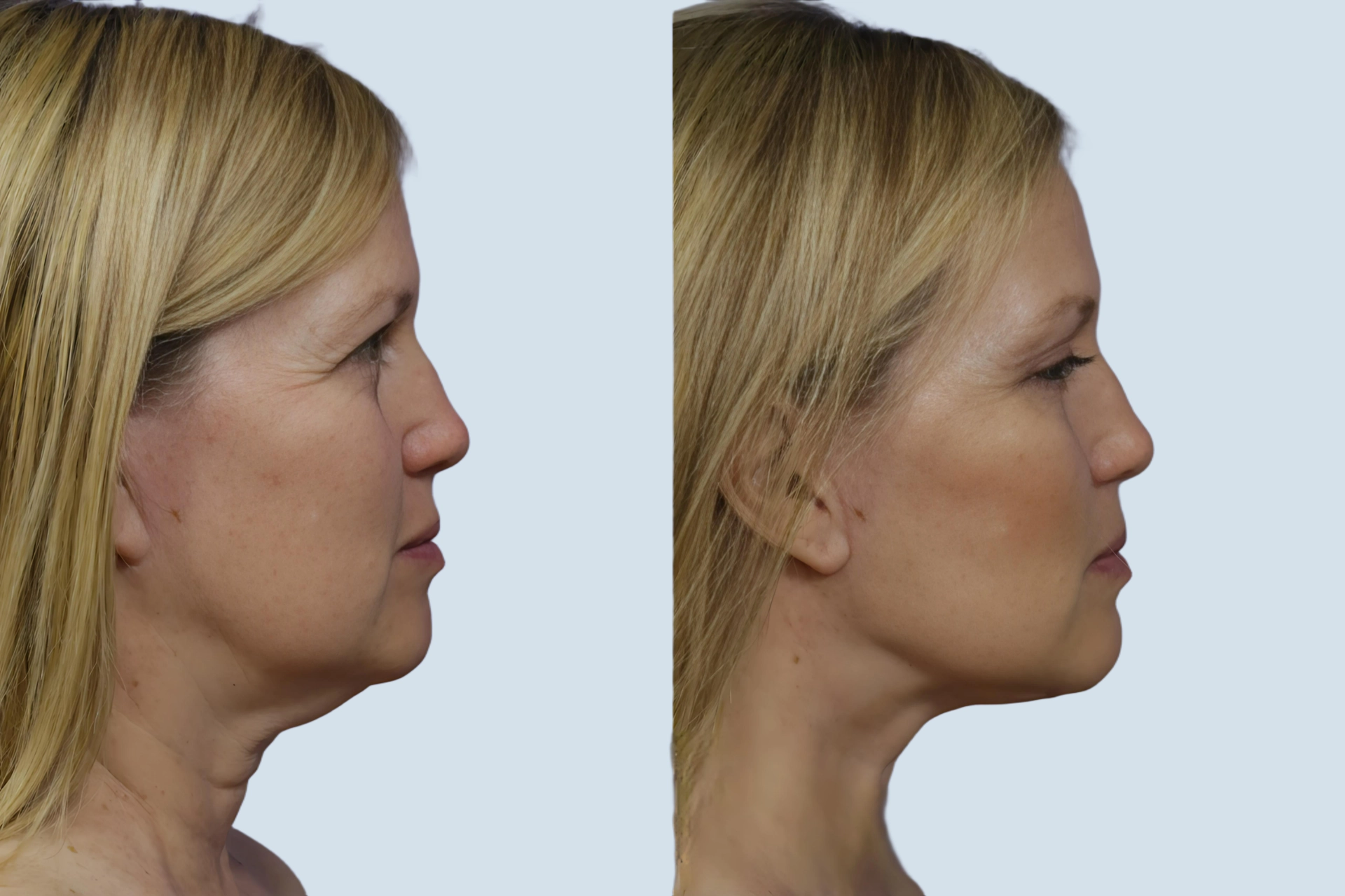 Facelift Turkey before and after Photo 17