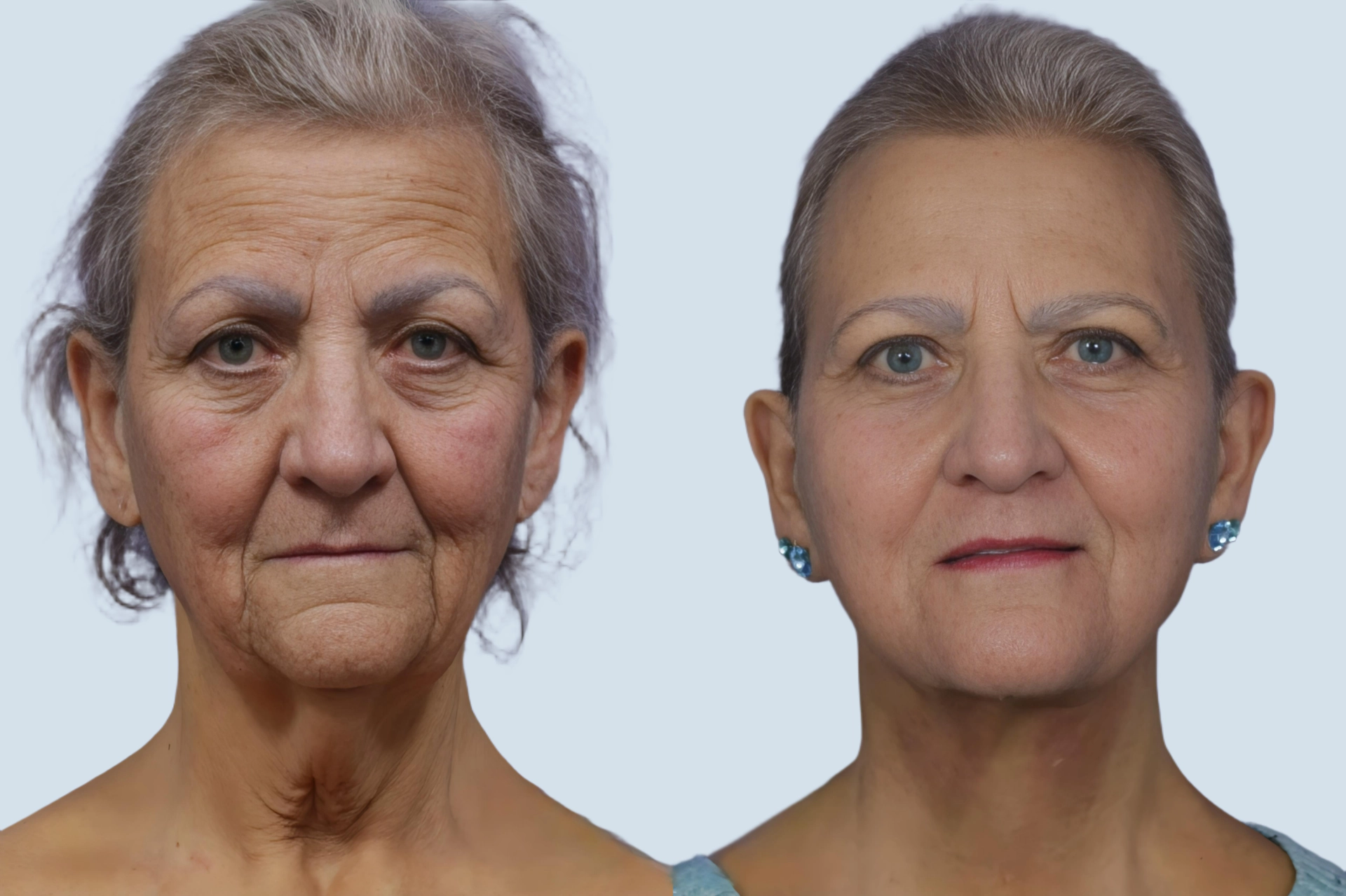 Facelift Turkey before and after Photo 16