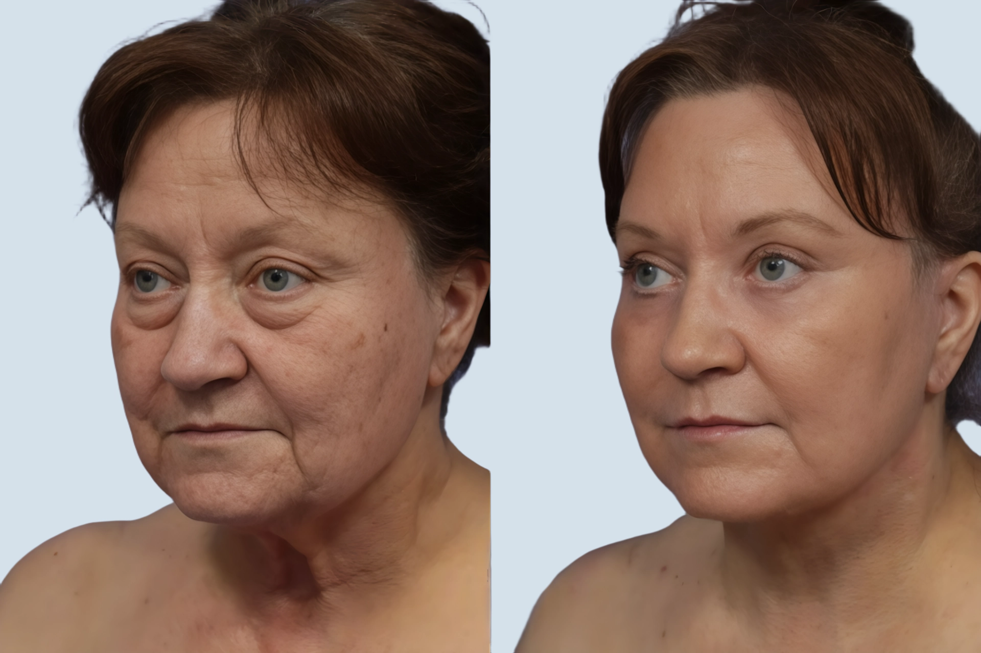 Facelift Turkey before and after Photo 33