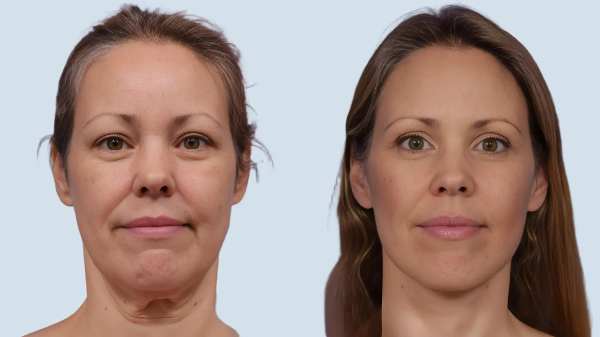 Facelift Turkey before and after Photo 14