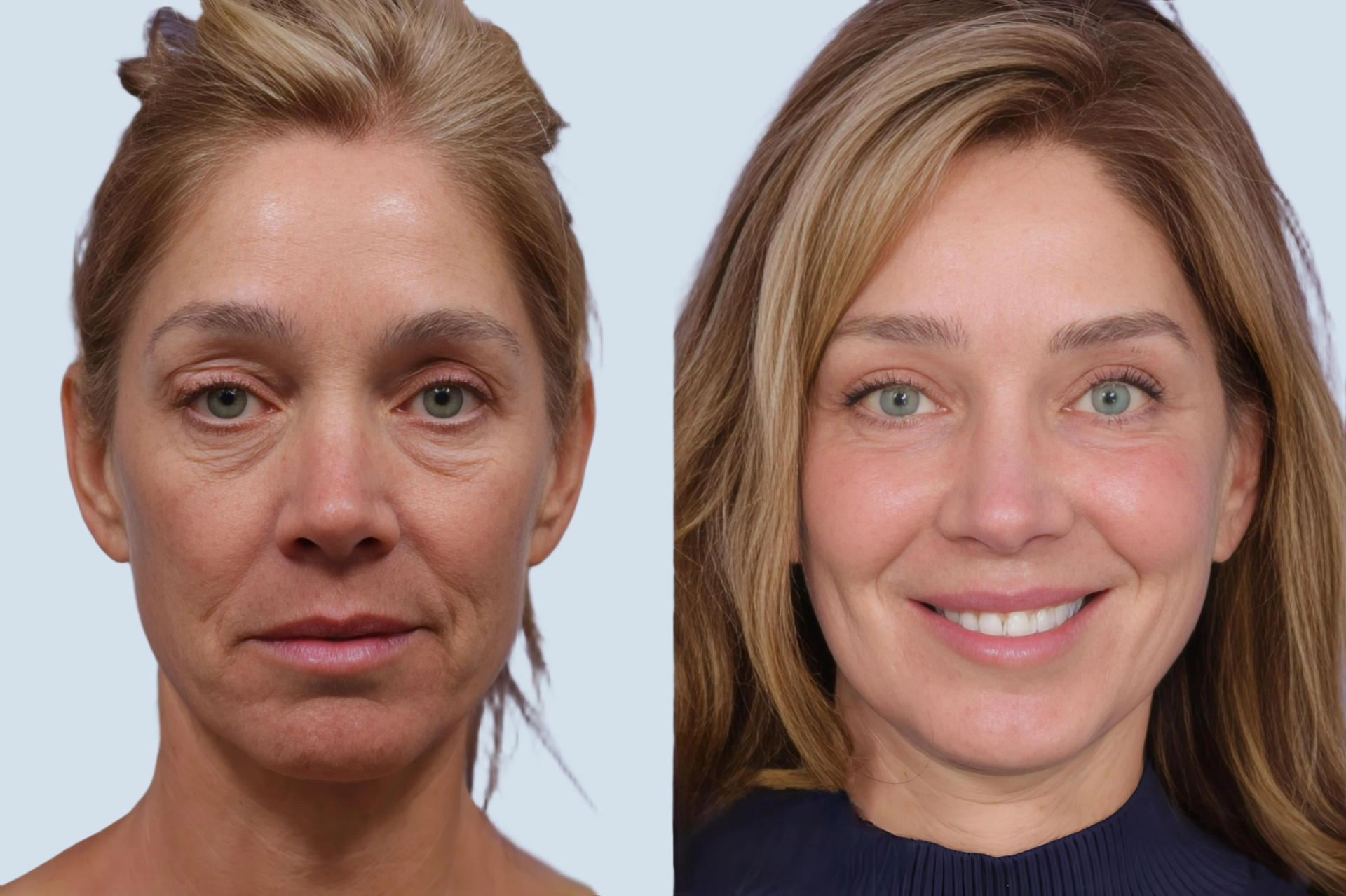 Facelift Turkey before and after Photo 12