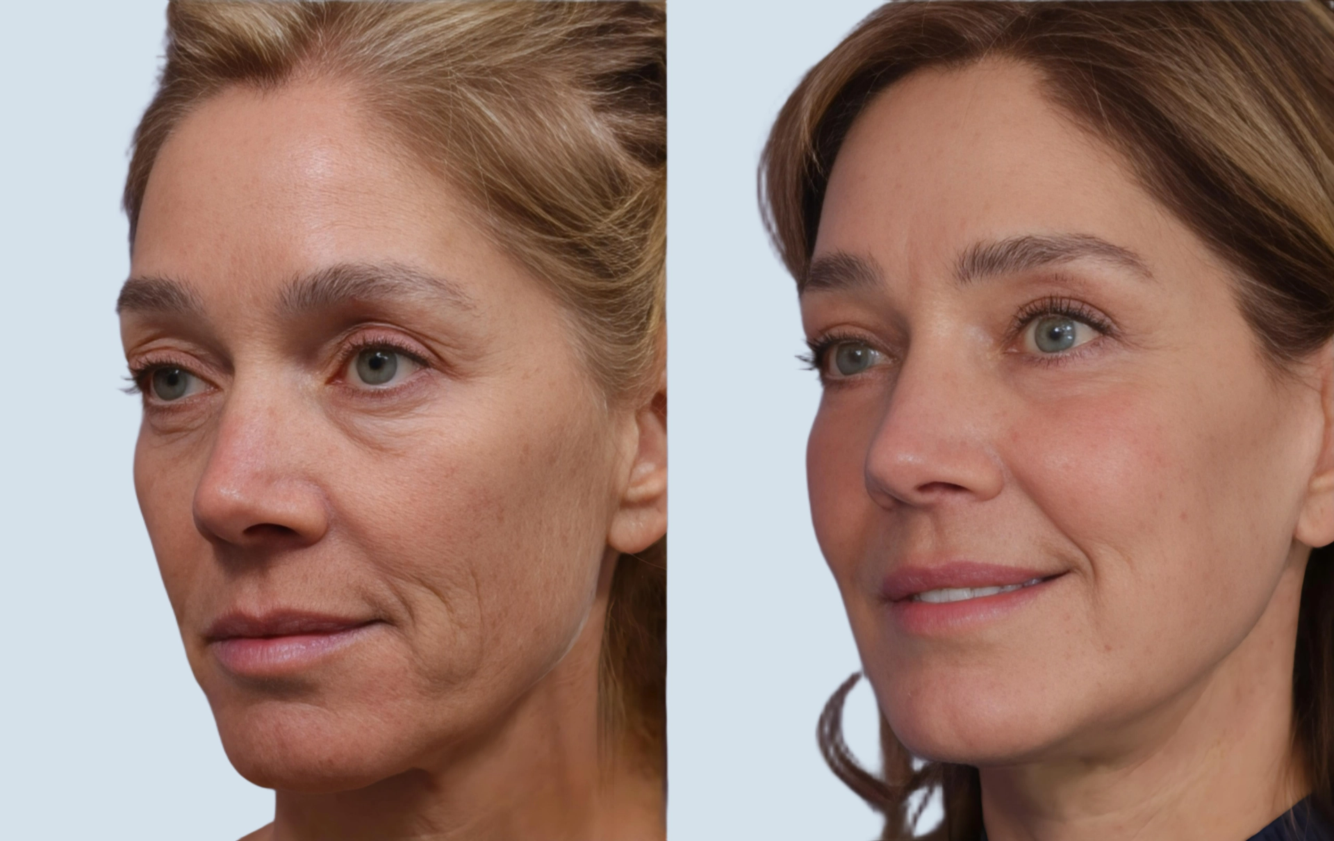 Facelift Turkey before and after Photo 11