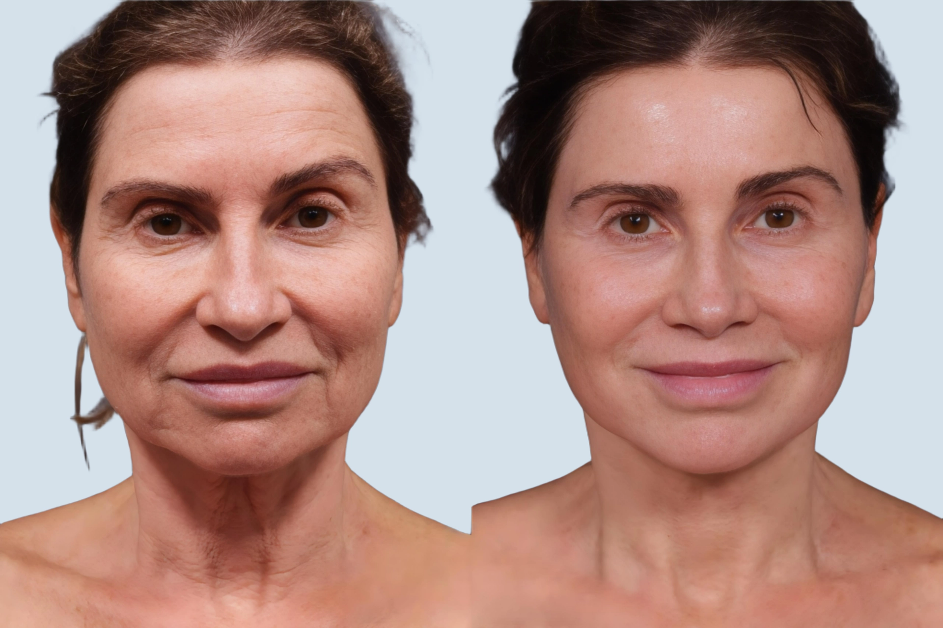 Facelift Turkey before and after Photo 10