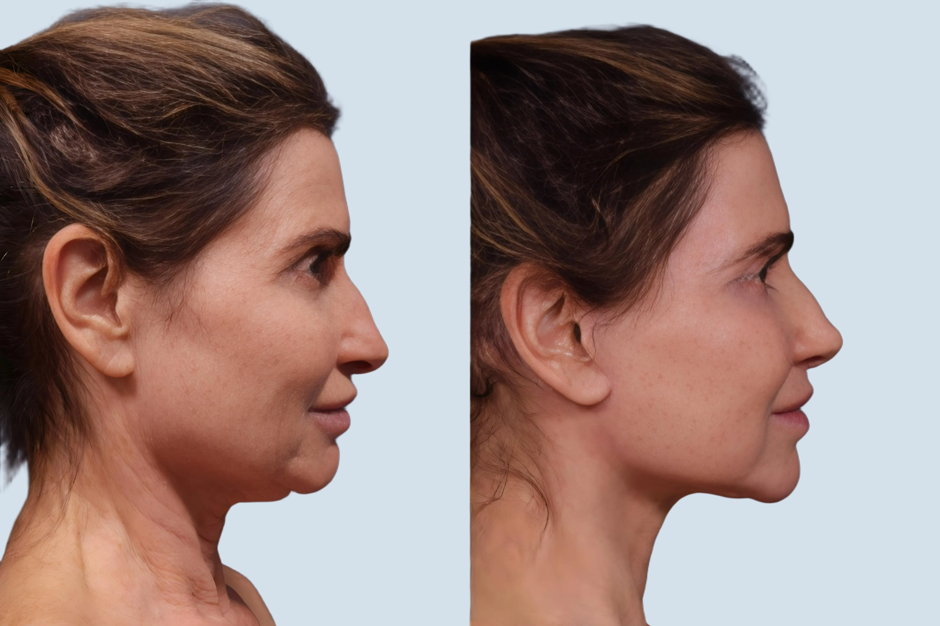 Facelift Turkey before and after Photo 9