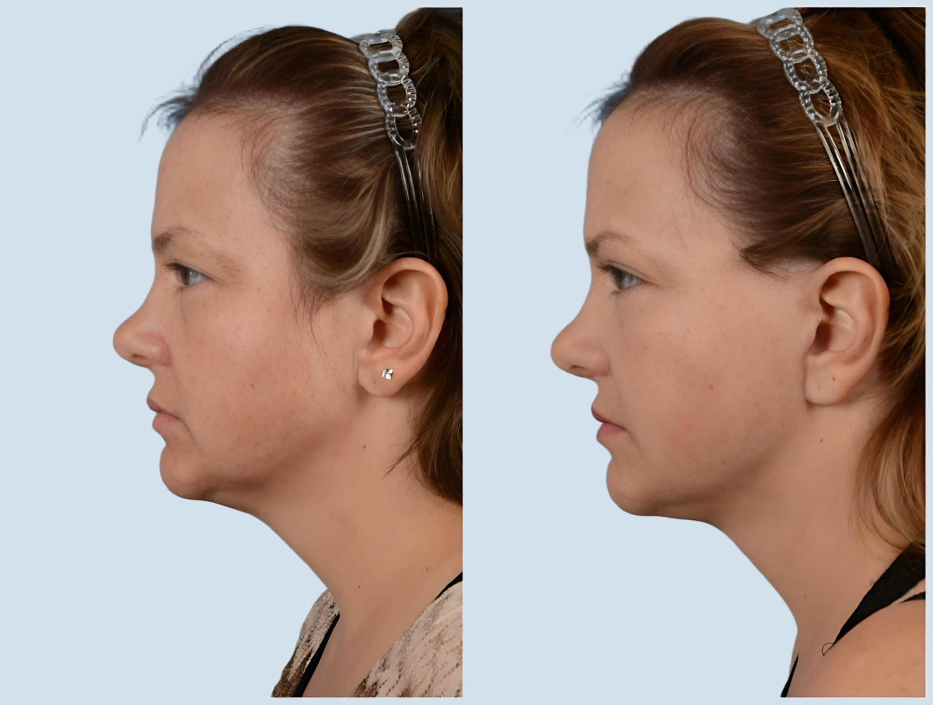 Facelift Turkey before and after Photo 7