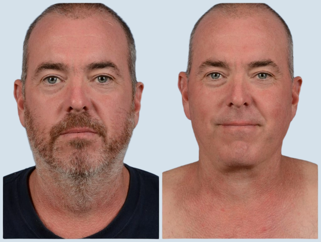 Facelift Turkey before and after Photo 6