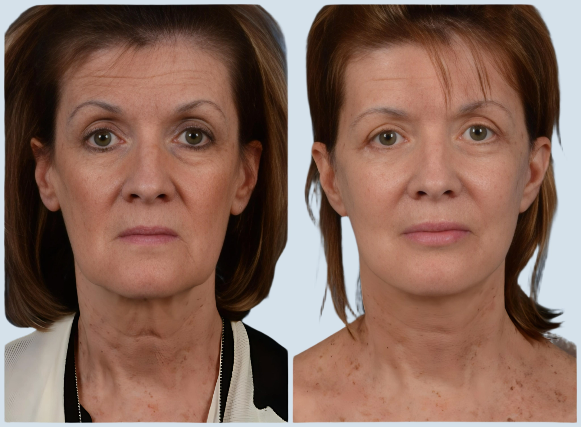 Facelift Turkey before and after Photo 4