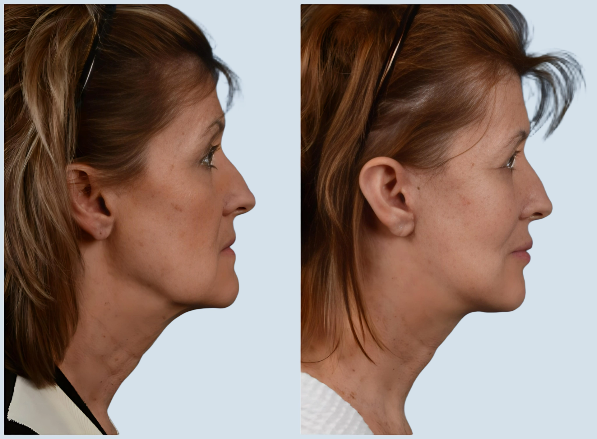 Facelift Turkey before and after Photo 3