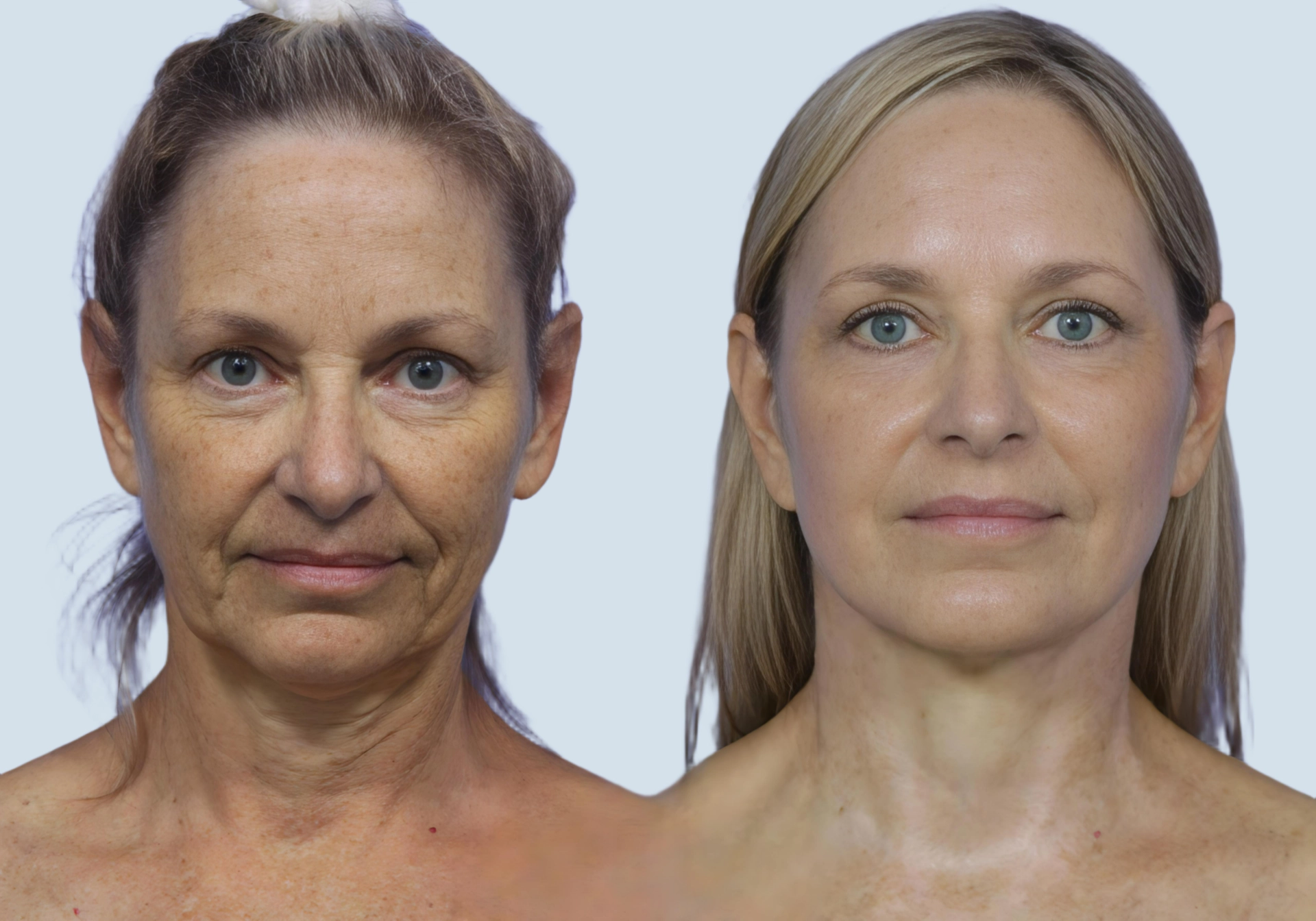 Facelift Turkey before and after Photo 30