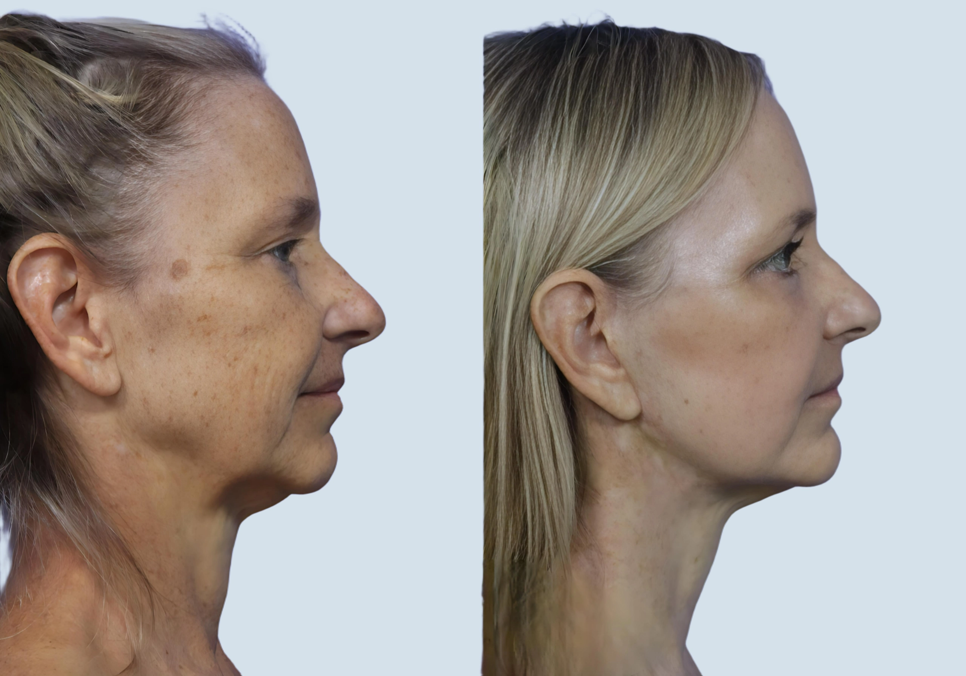 Facelift Turkey before and after Photo 29
