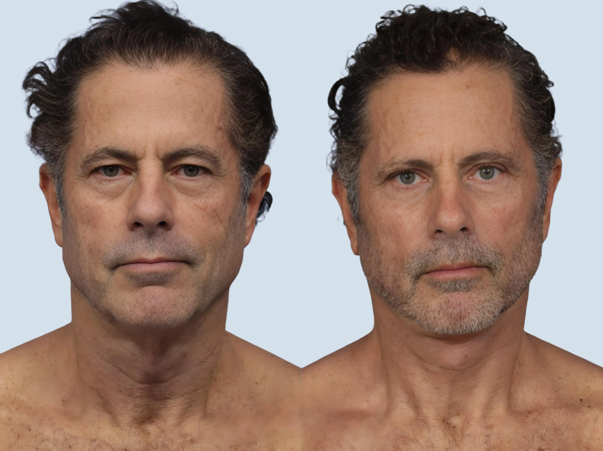 Facelift Turkey before and after Photo 28