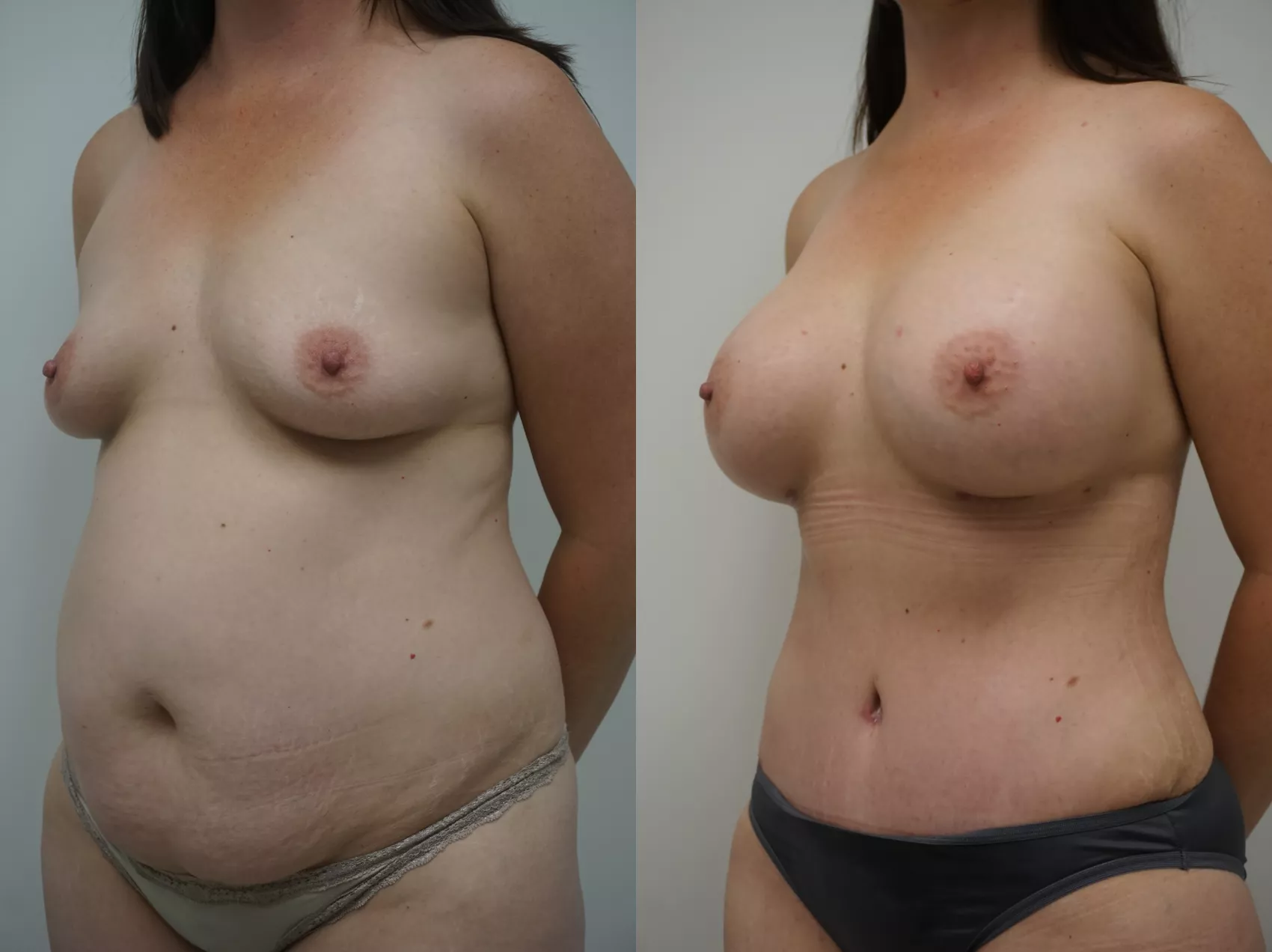 Liposuction Turkey before and after - fat removal results at Carely Clinic Istanbul