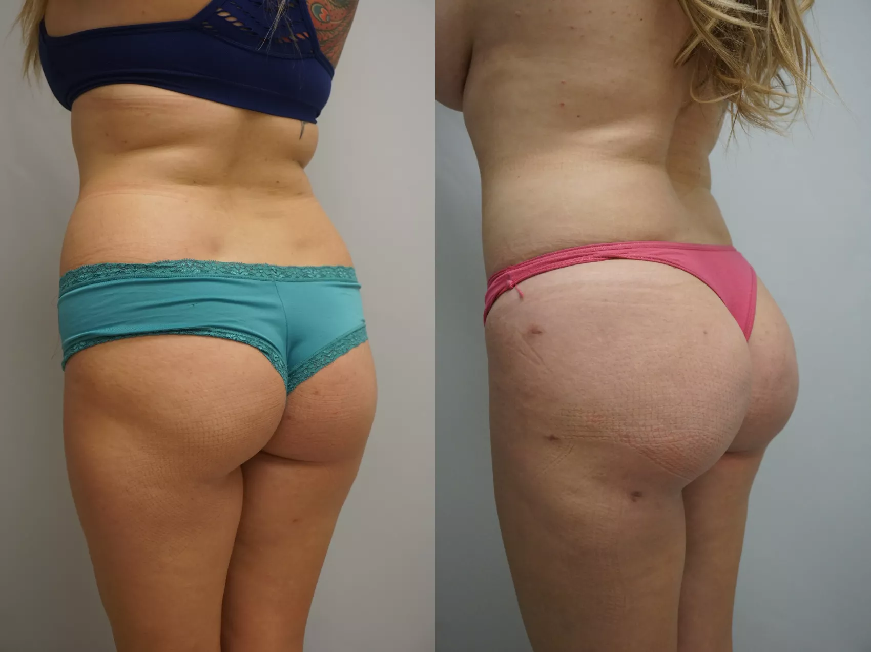 Liposuction Turkey Case 19