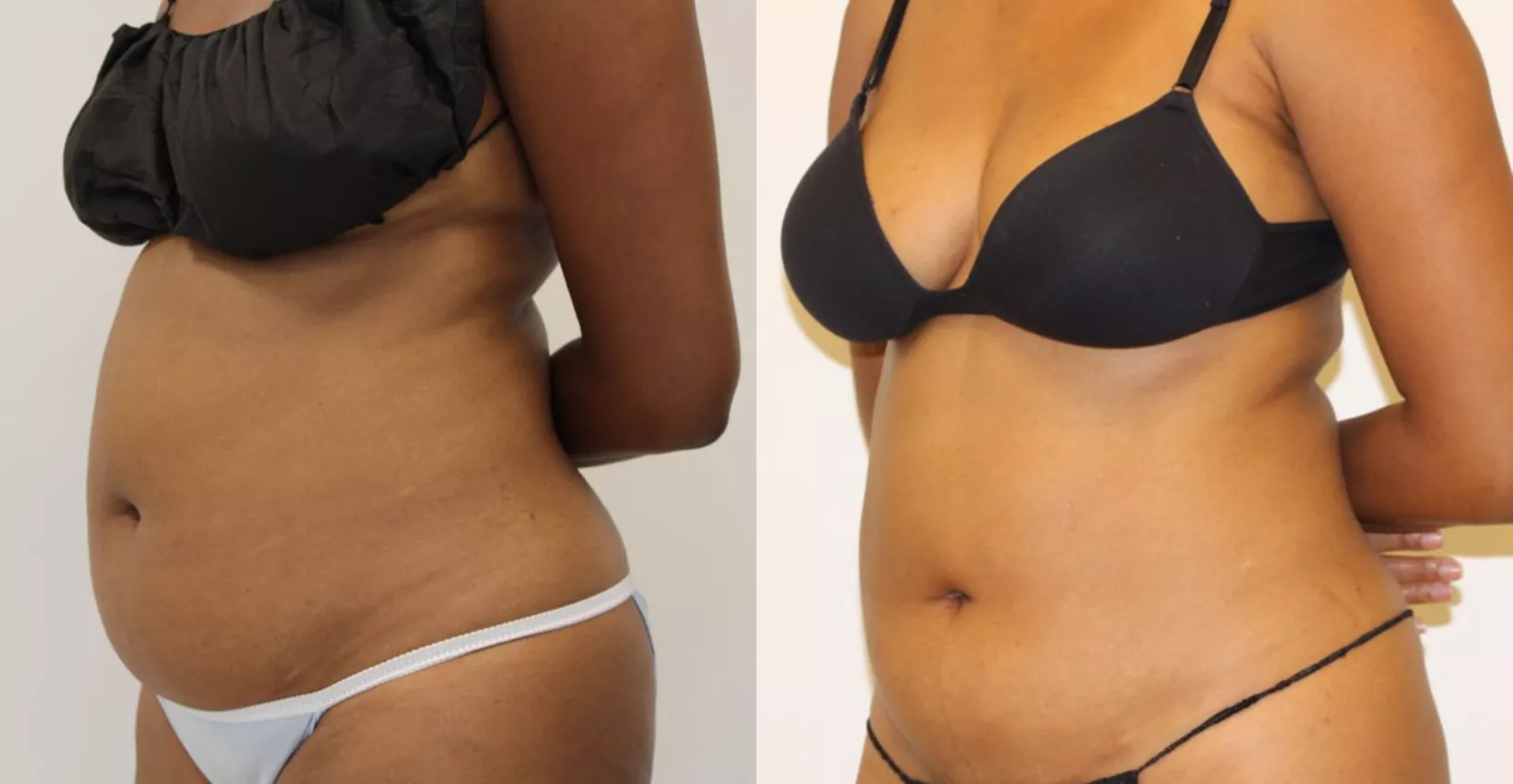 Liposuction Turkey Case 8 - Body sculpting transformation