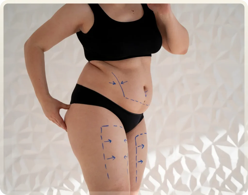 mommy makeover turkey 2026 at carely clinic