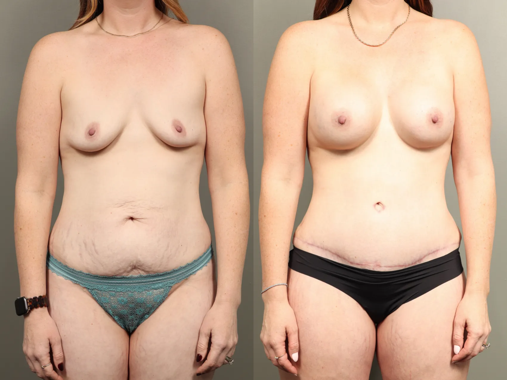 Mommy makeover Turkey before and after gallery