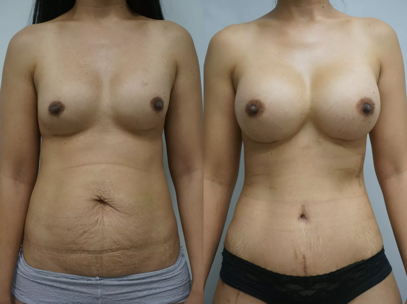 Mommy makeover Turkey Case 10