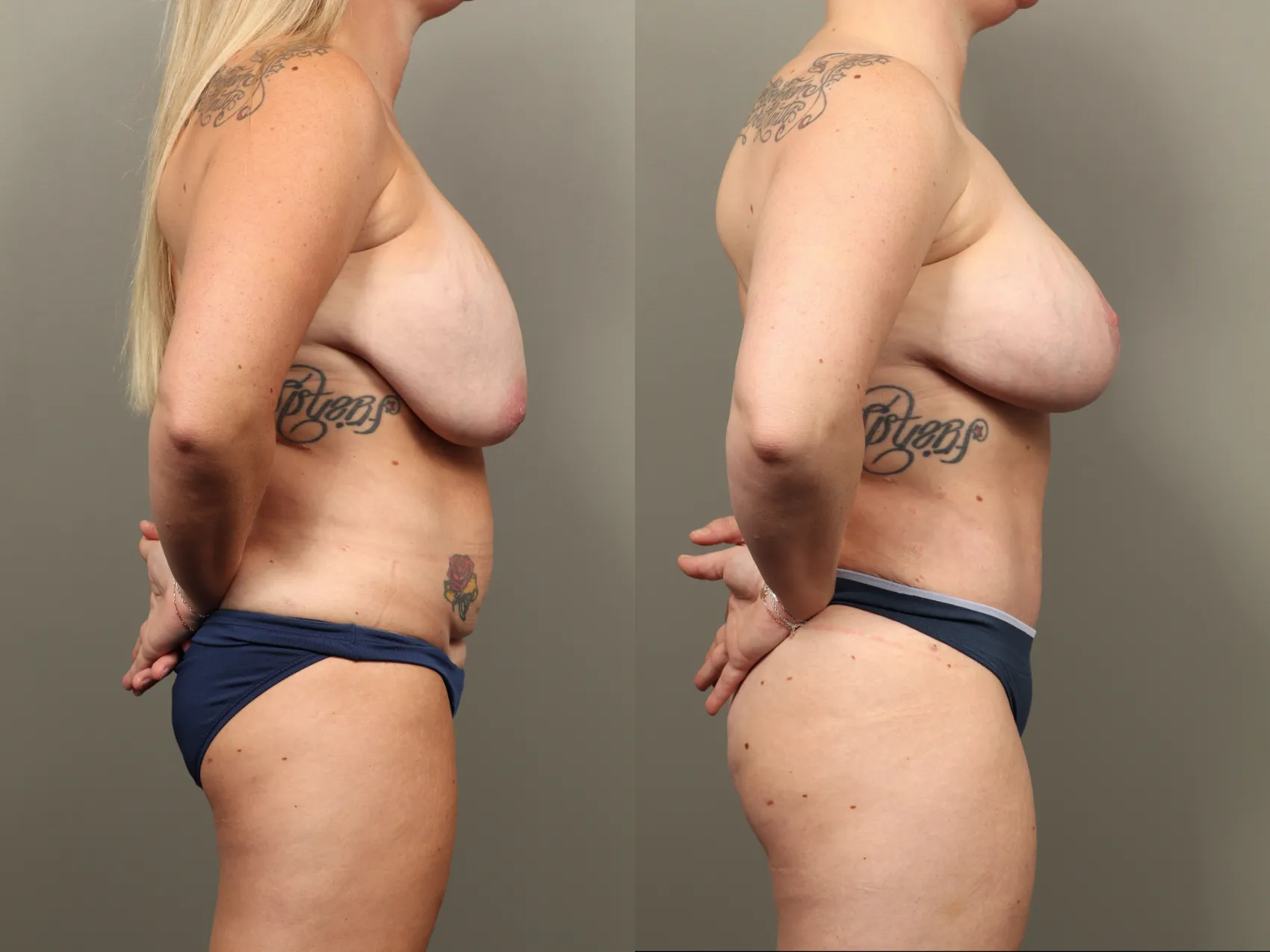 Mommy makeover Turkey Case 11