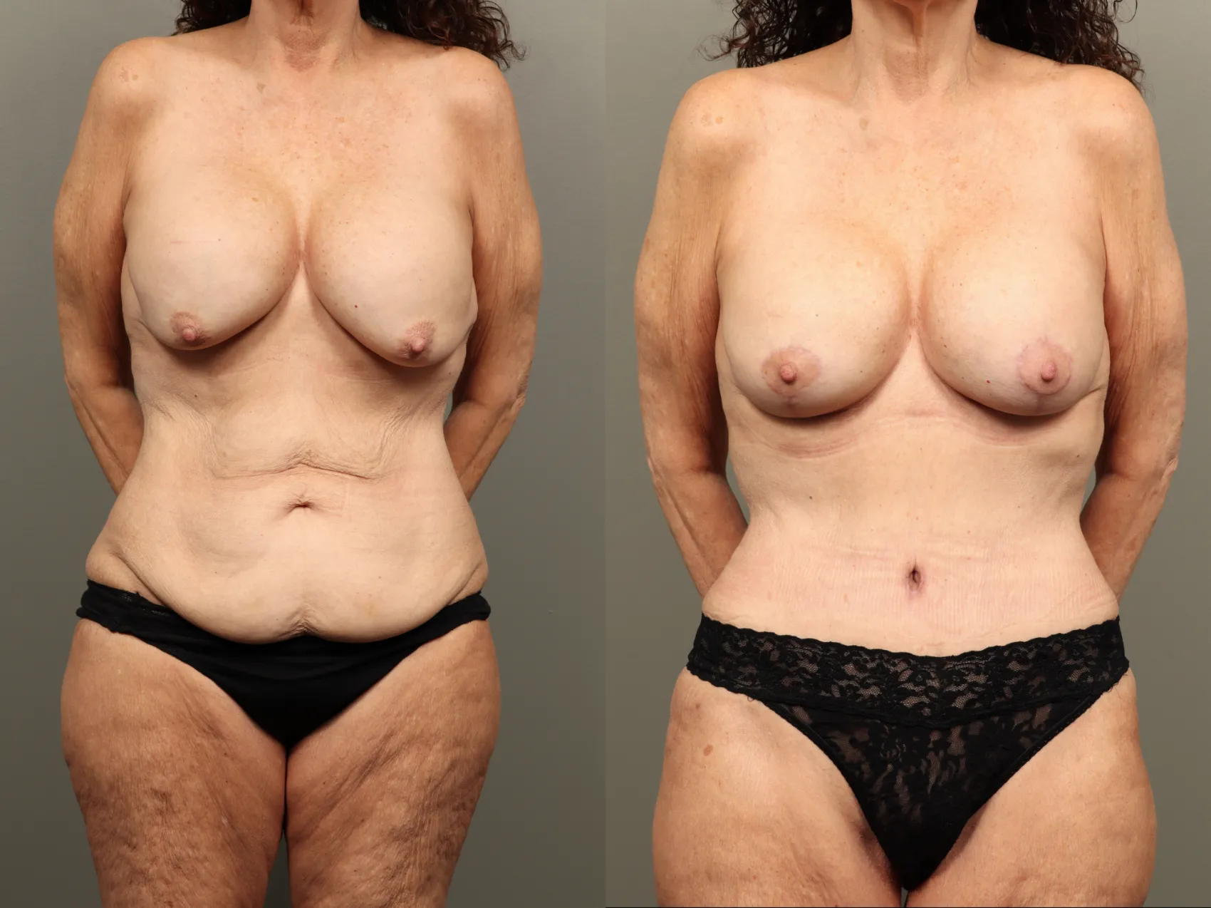 Mommy makeover Turkey Case 12