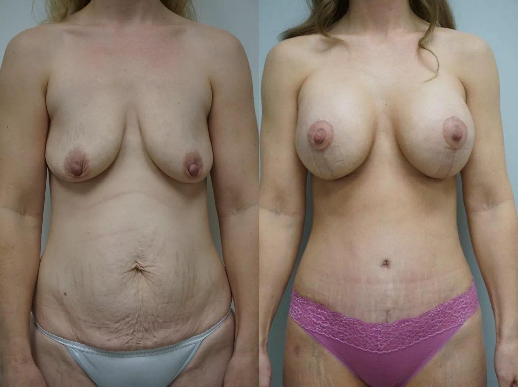 Mommy makeover Turkey Case 13