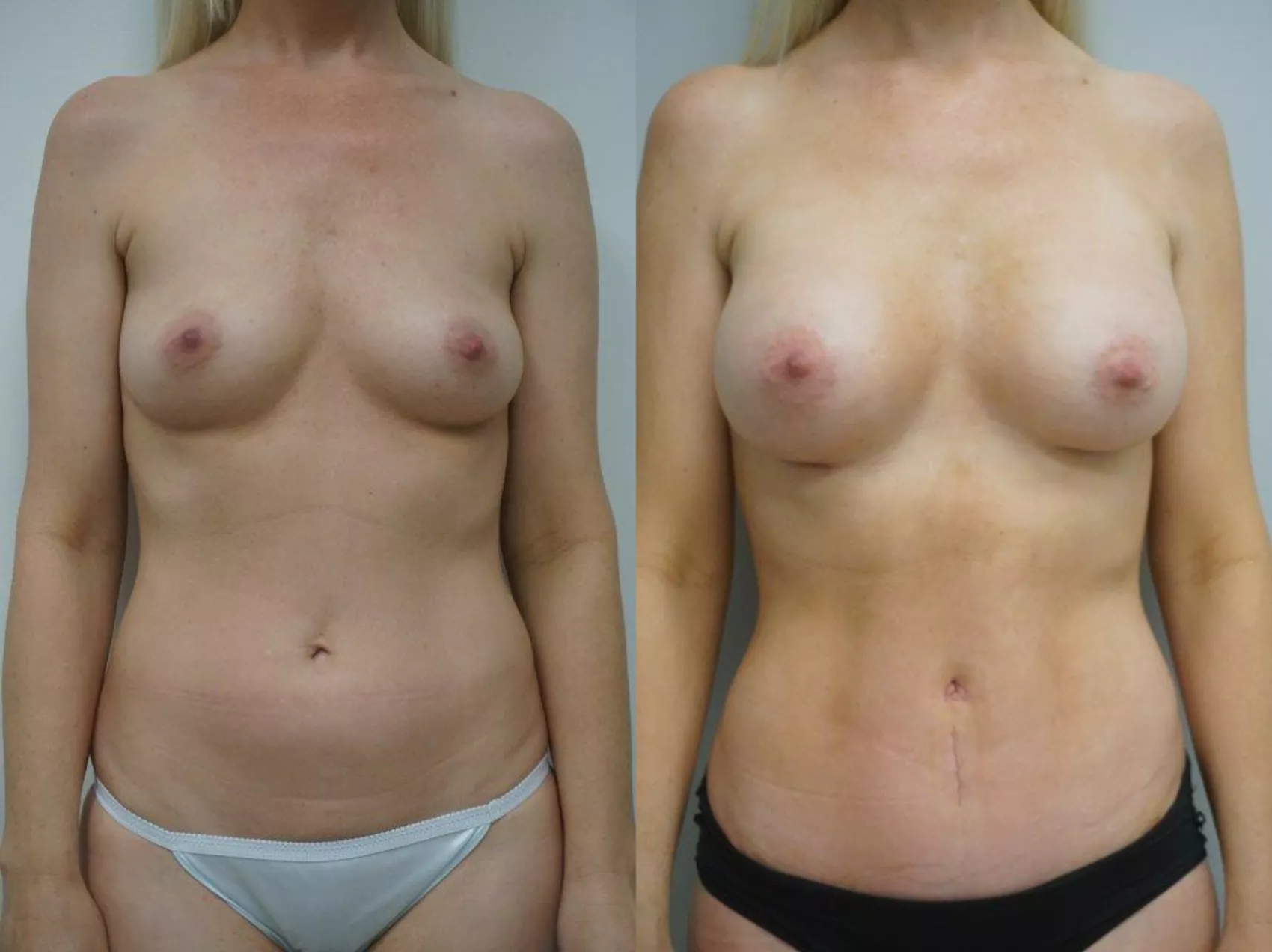 Mommy makeover Turkey Case 14