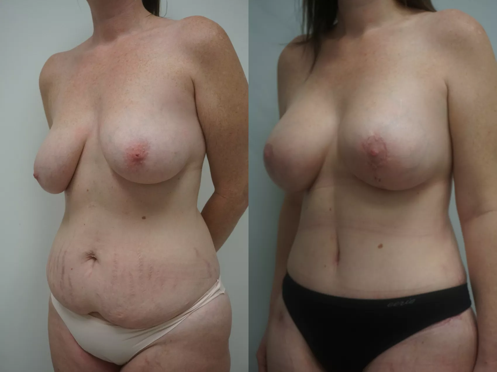 Mommy makeover Turkey Case 15