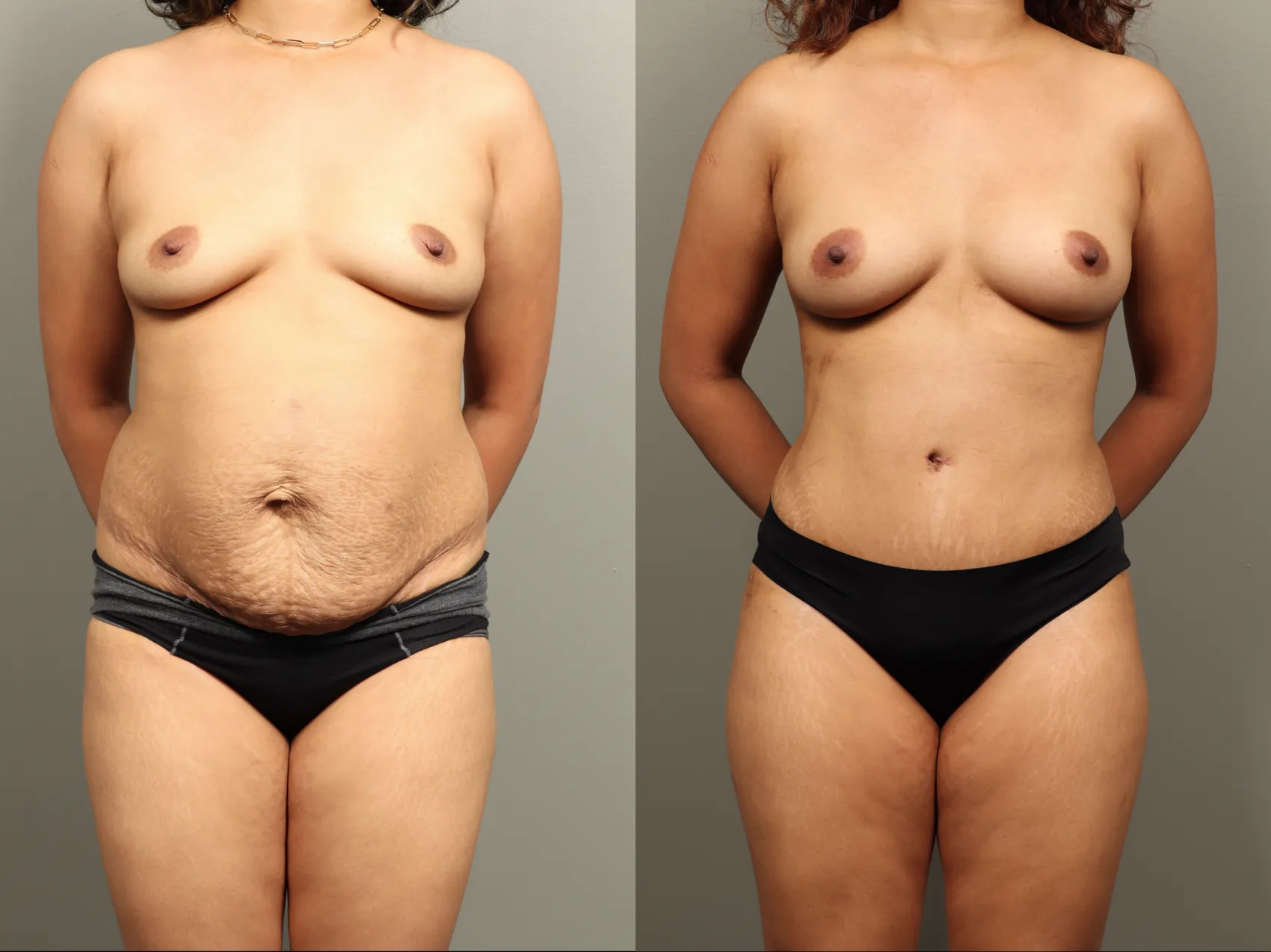 Mommy makeover Turkey Case 17