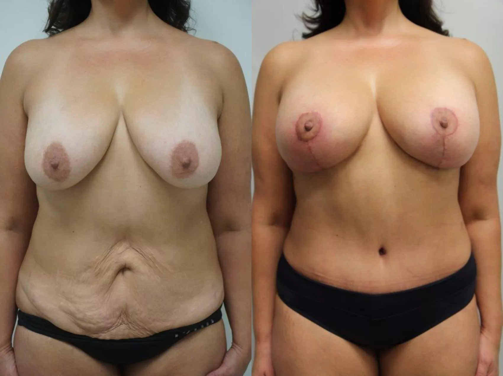 Mommy makeover Turkey Case 19