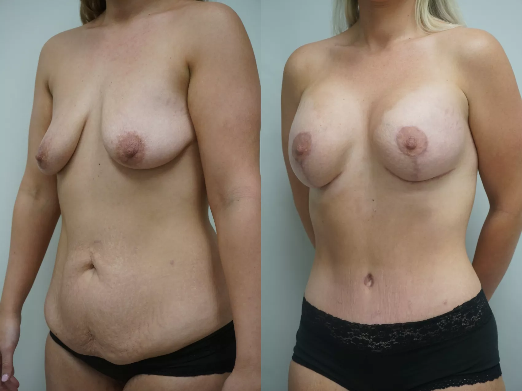 Mommy makeover Turkey before and after Case 2 - Tummy tuck breast lift lipo results