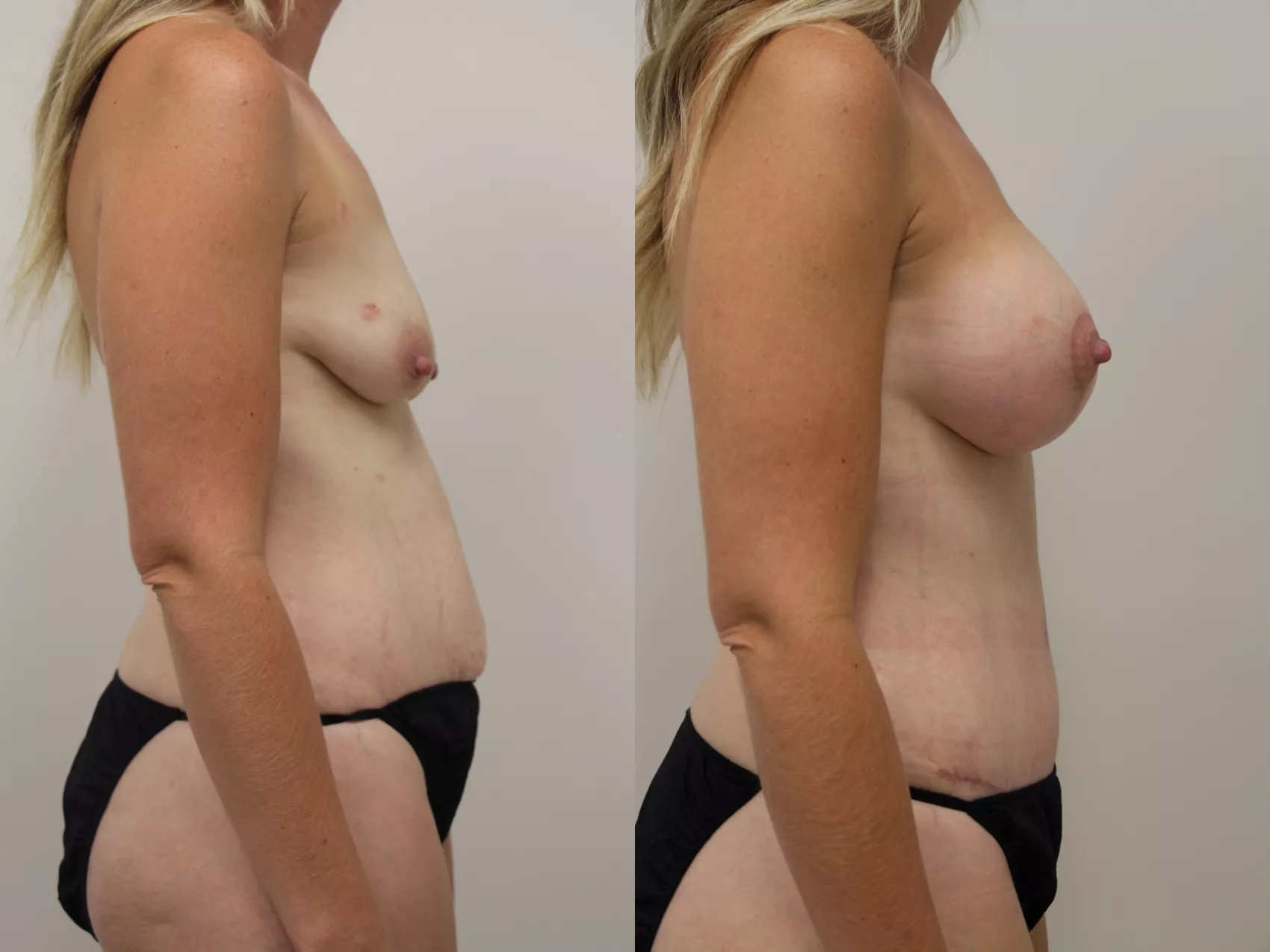 Mommy makeover Turkey Case 32