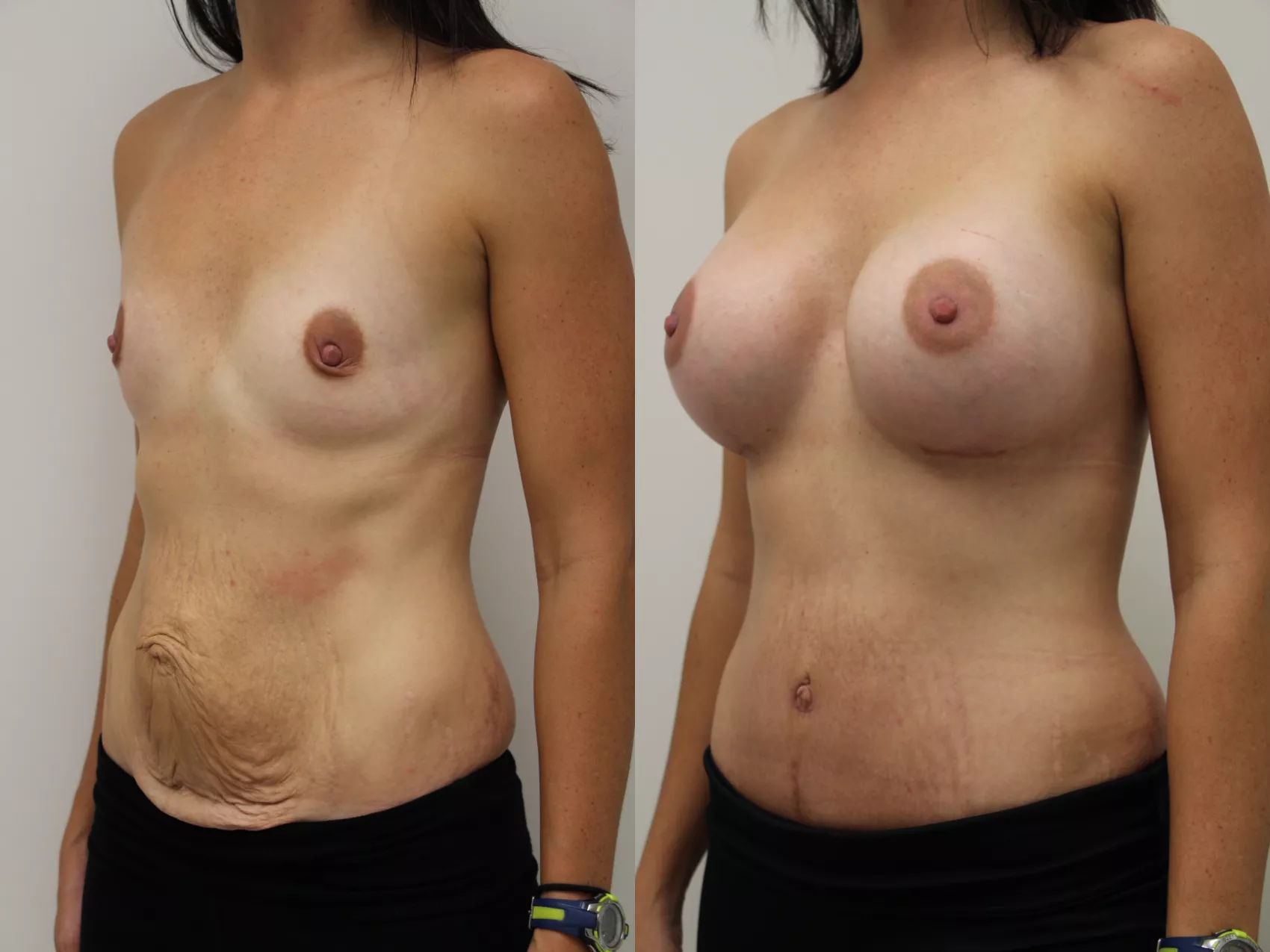 Mommy makeover Turkey Case 33