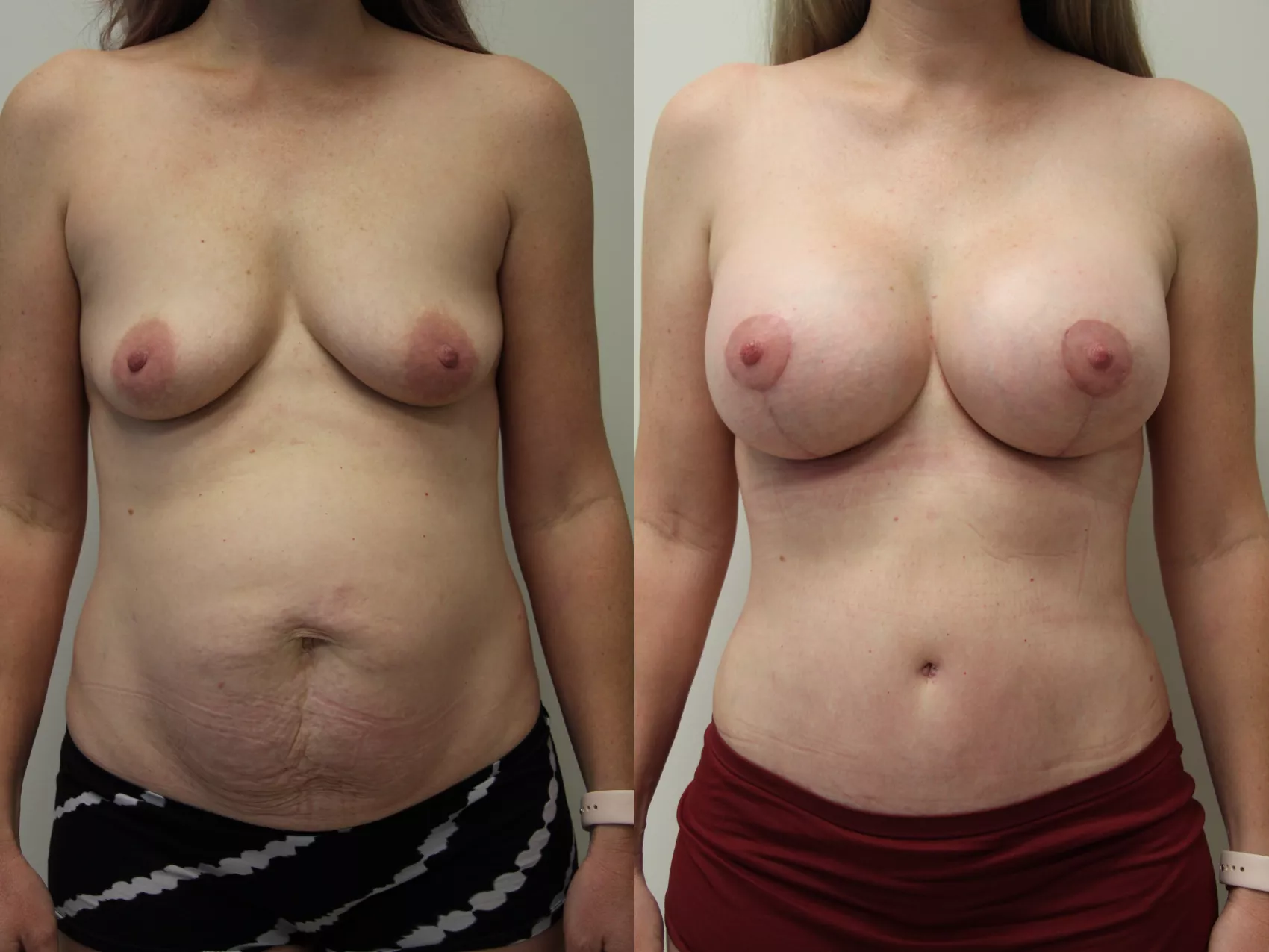 Mommy makeover Turkey Case 36