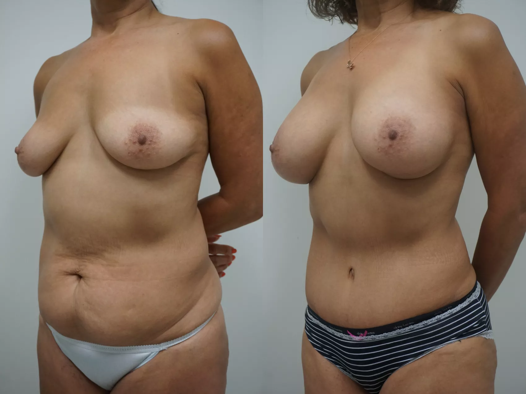 Mommy makeover Turkey Case 4 - Abdominoplasty with breast surgery
