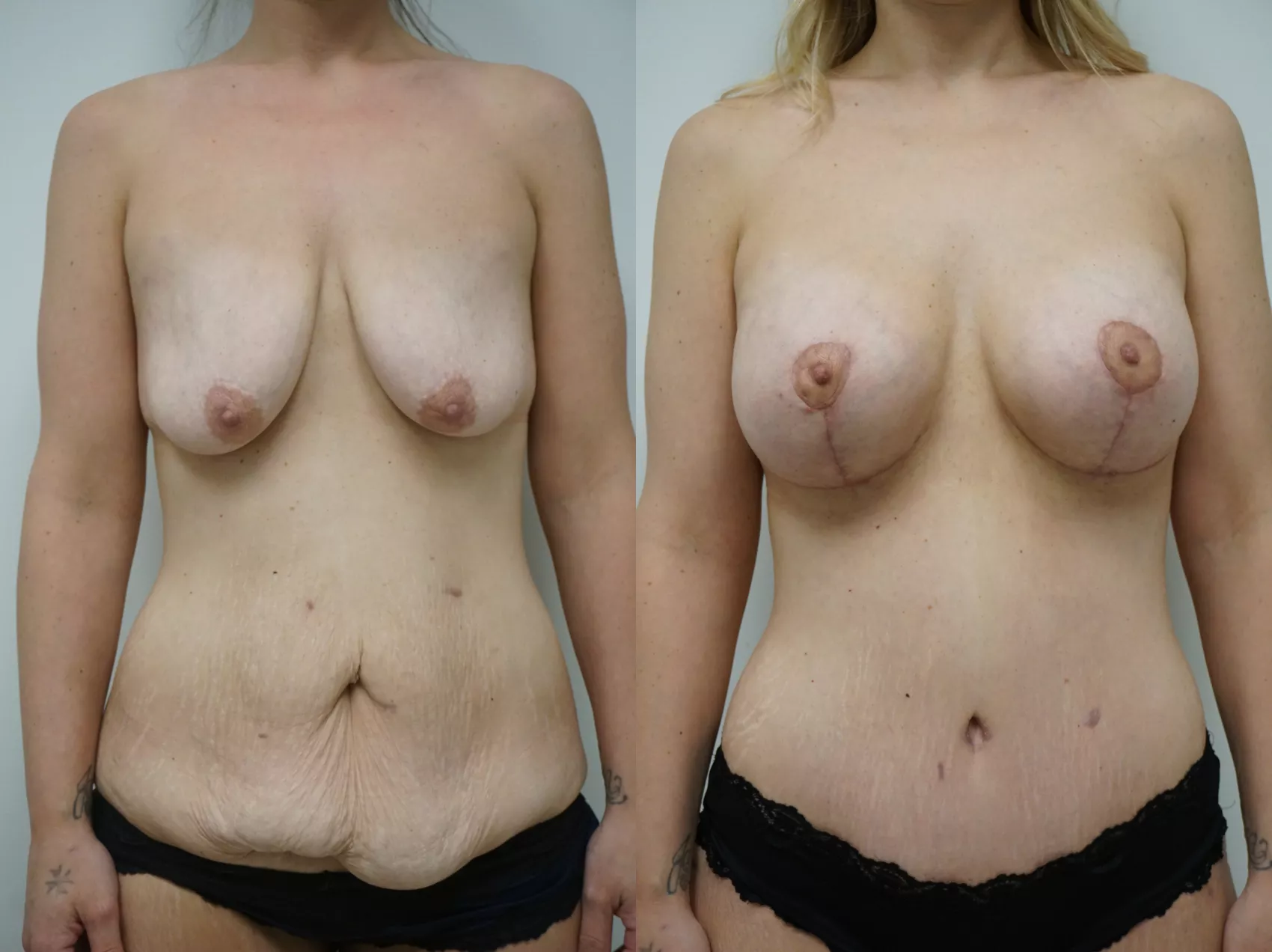 Mommy makeover Turkey Case 40