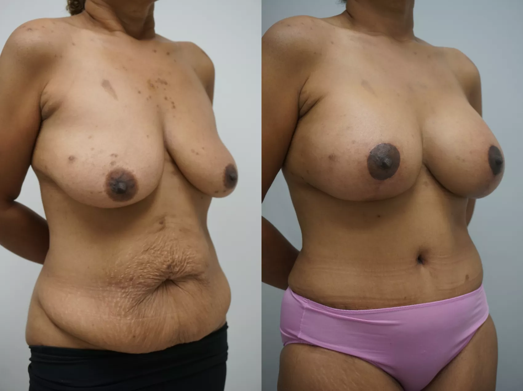 Mommy makeover Turkey Case 6 - Combined procedure transformation